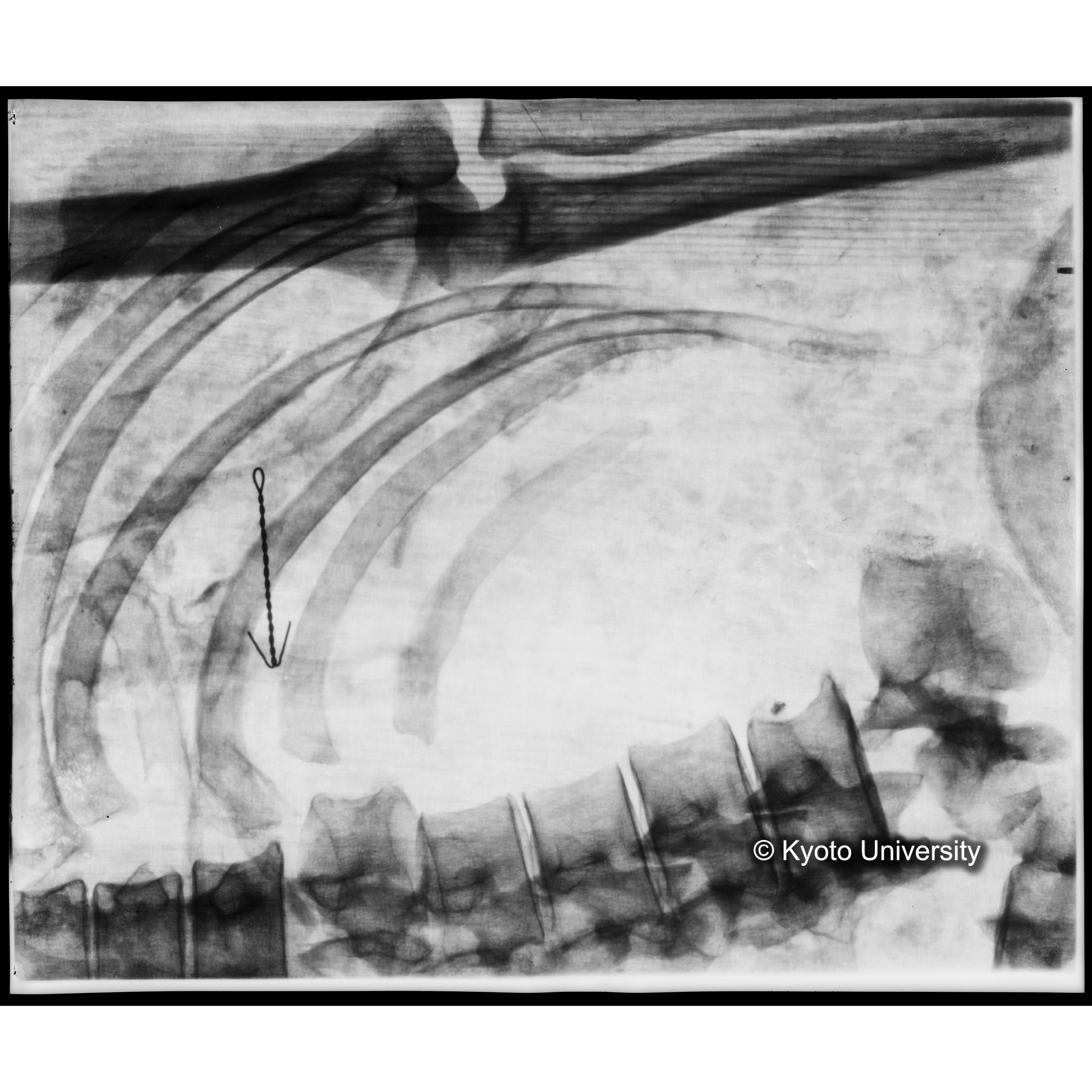 [写真内容] 胸部レントゲン (1)
