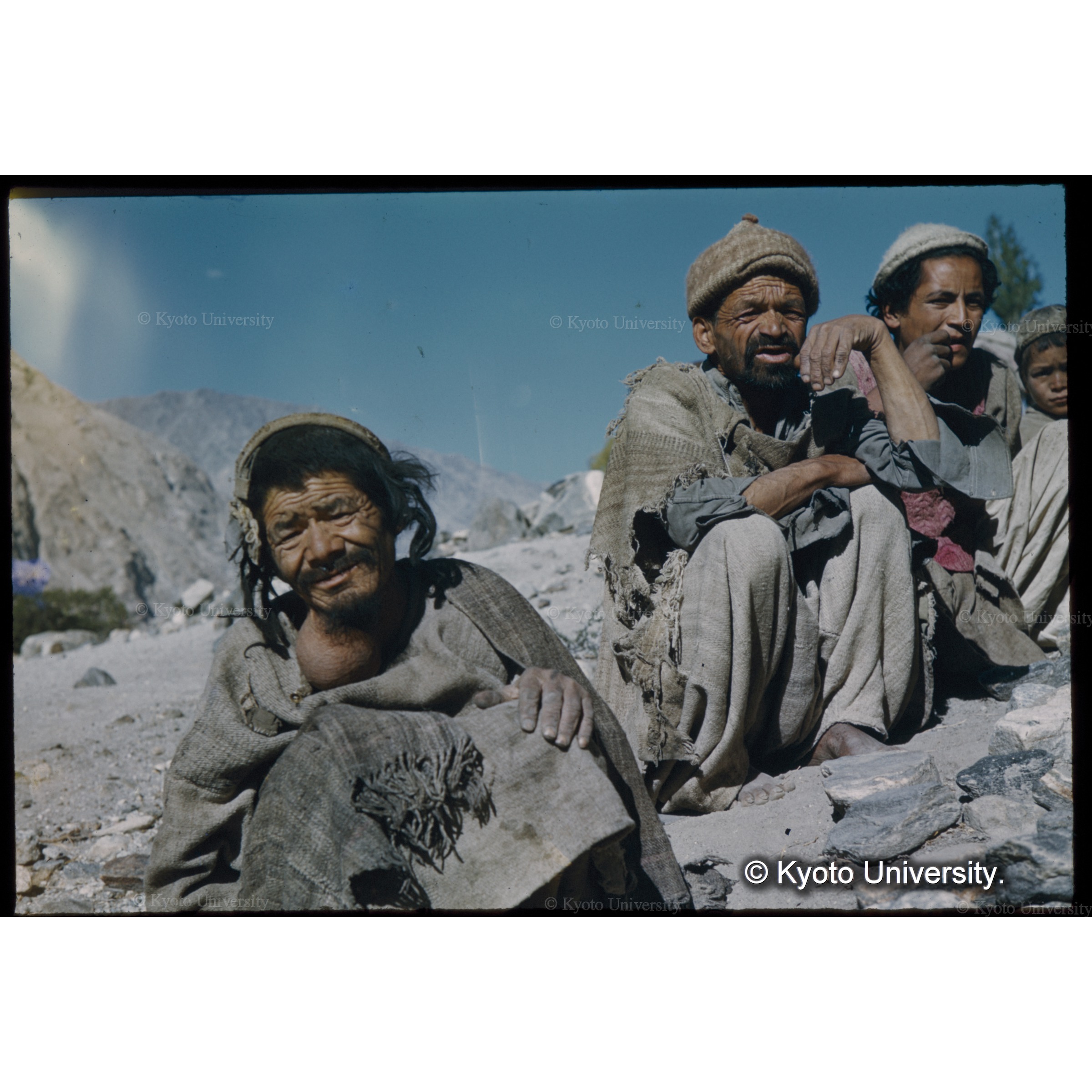 ヨード欠による甲状腺腫がひじょうに多い (1)